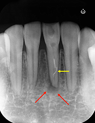 根尖性歯周炎のMTAセメントを用いた根管治療例②（根管充填後）