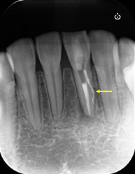 根尖性歯周炎のMTAセメントを用いた根管治療例②（根管充填後）