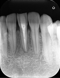 根尖性歯周炎のMTAセメントを用いた根管治療例②（術後）