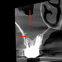 根尖性歯周炎のMTAセメントを用いた根管治療例①（術前1）