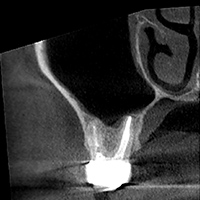根尖性歯周炎のMTAセメントを用いた根管治療例①（術後1年-1）