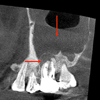 根尖性歯周炎のMTAセメントを用いた根管治療例①（術前2）