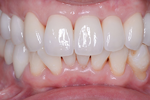 位置不正歯の治療例（施術後）