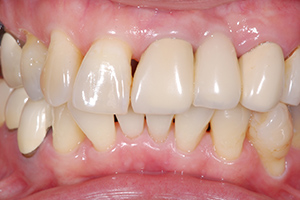 位置不正歯の治療例（施術前）