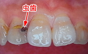 虫歯（カリエス・うしょく歯）の有無と進行程度