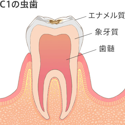 C1の虫歯