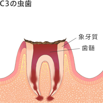 C4の虫歯