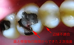 隙間が歯周病や虫歯を引き起こす