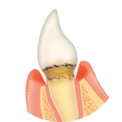 軽度歯周病のイラスト（歯周ポケット4～5mm）