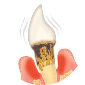 重度歯周病のイラスト（歯周ポケット6mm以上）