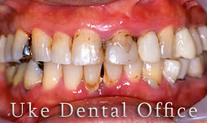 歯周病治療症例 50代男性（施術前）