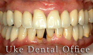 歯周病治療症例 50代男性（施術後）