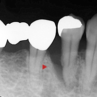 歯周病初期治療症例 49歳女性（術前）