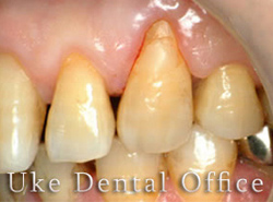 GTR法による歯周組織の再生