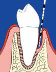 歯周病治療により歯が長く見えるようになる