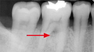 歯周組織再生療法後