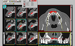 CT画像によるインプラント治療シミュレーション