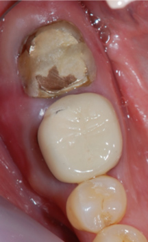 歯の移植の治療前後の写真