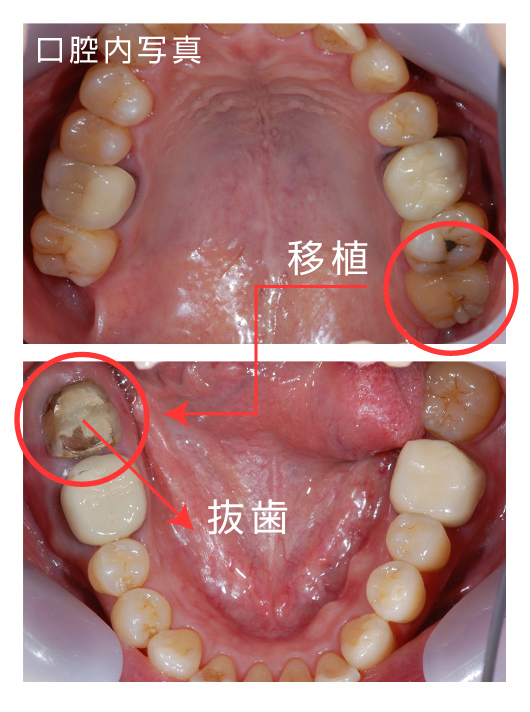 歯の移植の症例写真