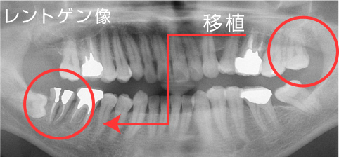 歯の移植のレントゲン写真