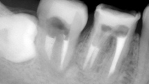 移植歯の根の治療